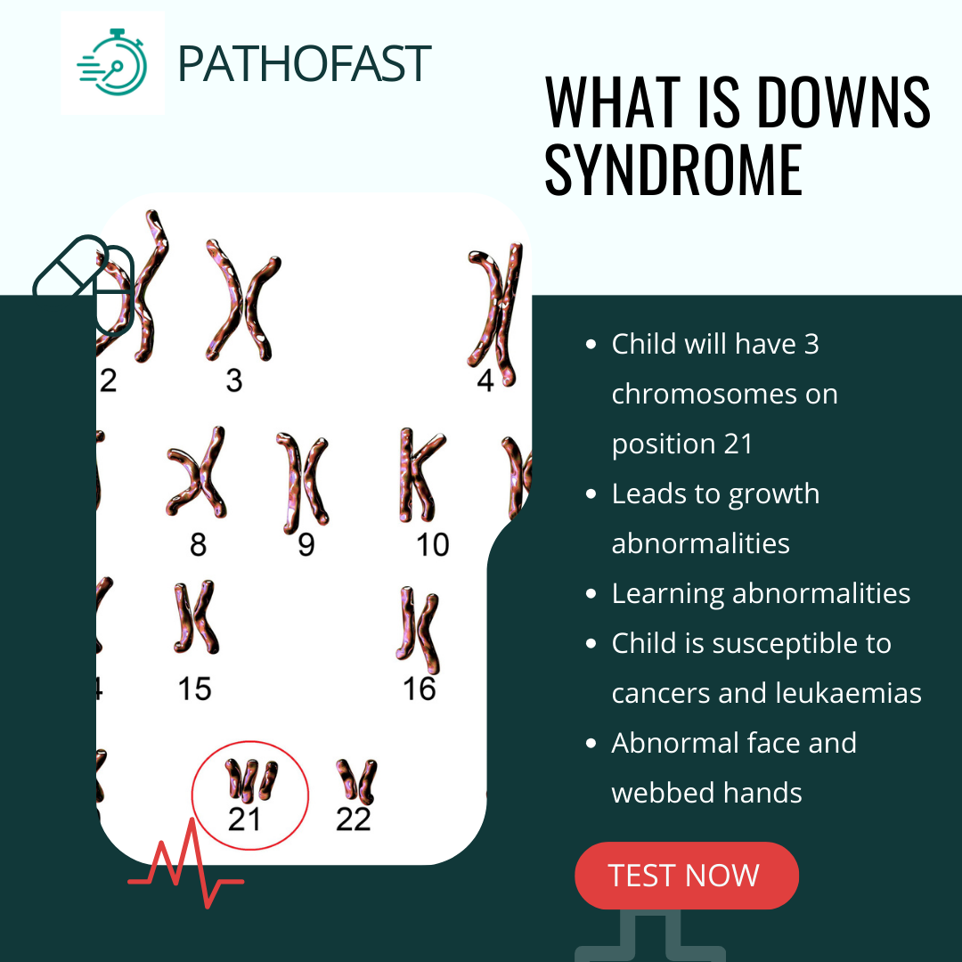 What is Down's Syndrome?