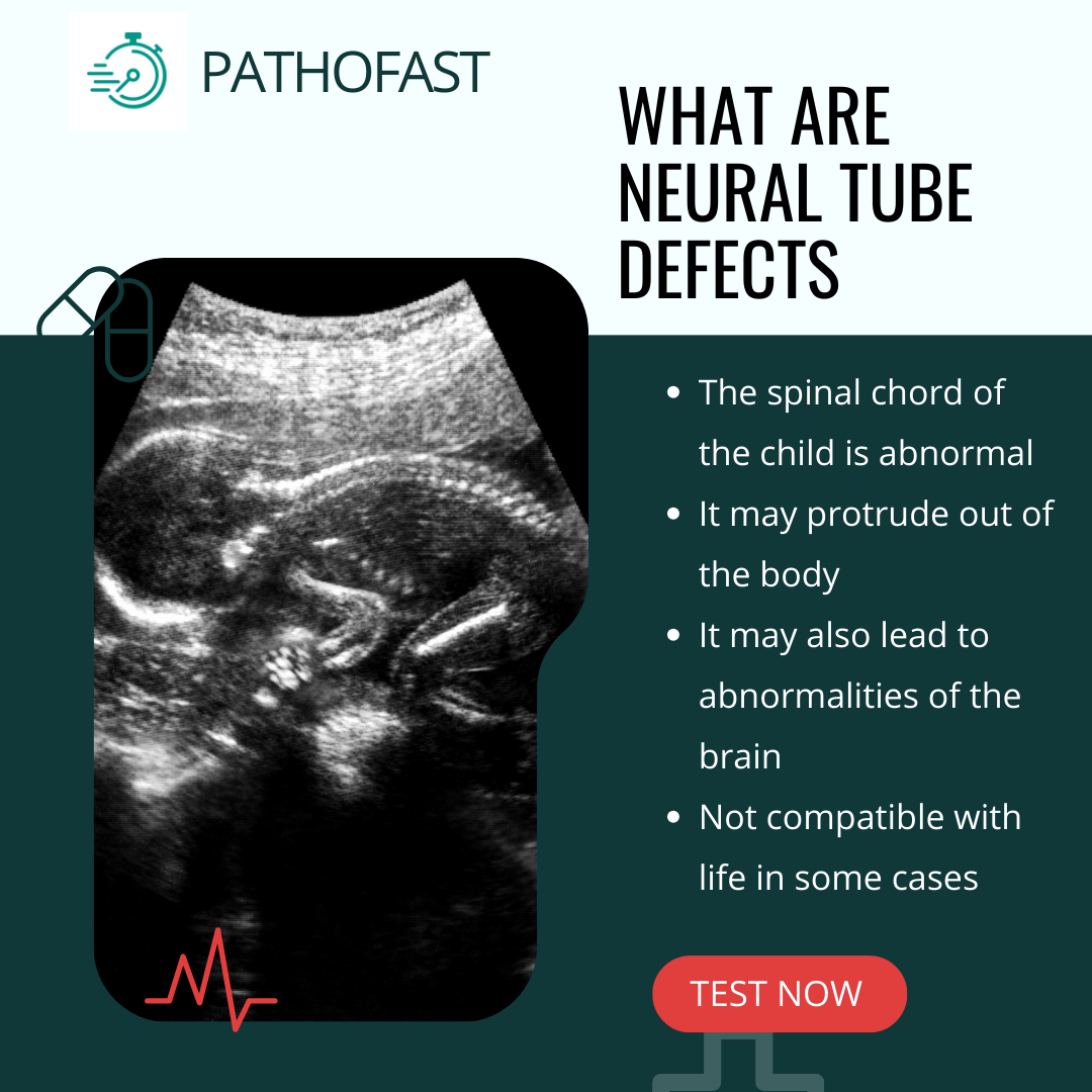 What are Neural Tube Defects?